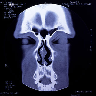 コーンビームCT